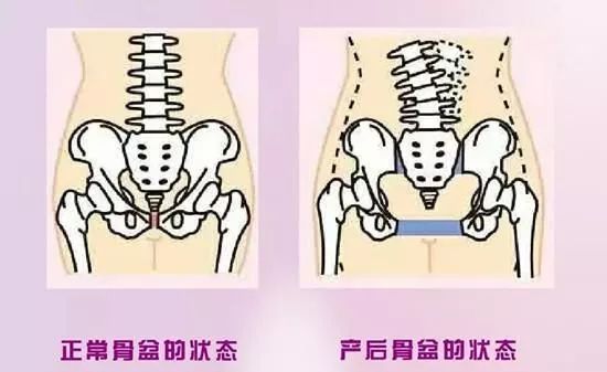 产后恢复有没有必要做？产后恢复是什么？产后骨盆“变大”怎么办？