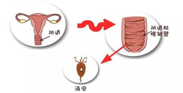 产后恢复培训，阴道炎的这些误解，害了多少女性！如何预防阴道炎？