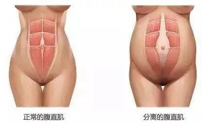腹直肌分离会不会造成盆底肌松弛吗？