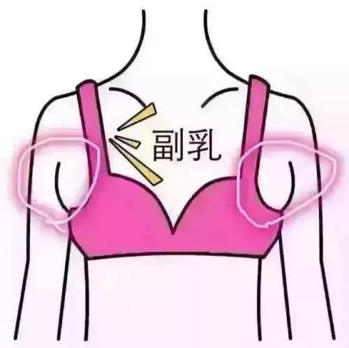 产后恢复项目：产后副乳，你以为只是不美观而已？可能会导致乳房疾病！