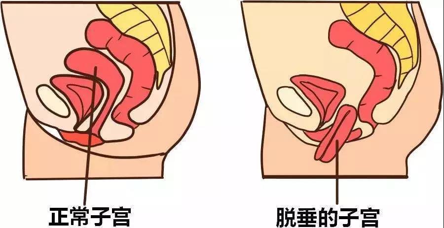 产后恢复有哪些项目？知道产后子宫下垂吗？原来有这些严重后果！