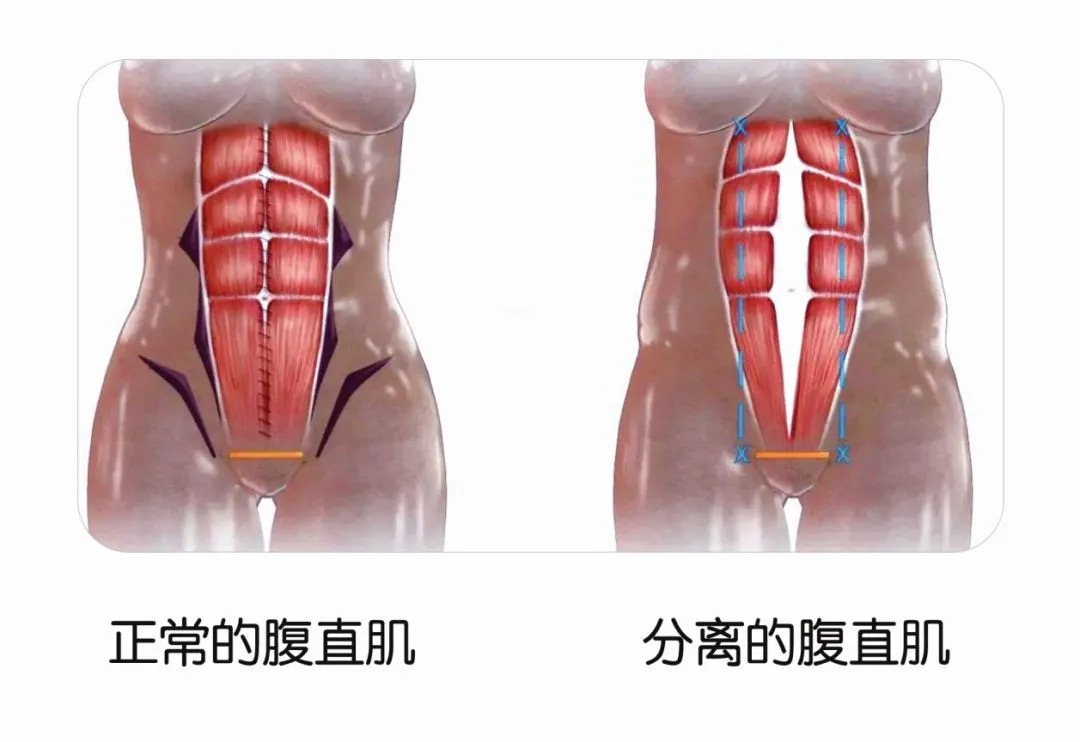 特殊时期也要做产后恢复！漂亮妈妈更加不能忽视这些！