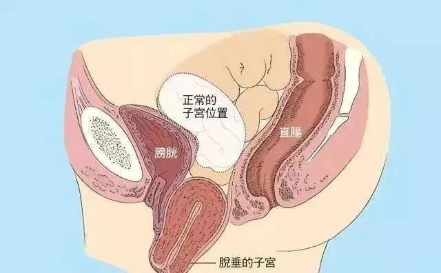 产后阴道壁膨出等产后问题，想靠自我恢复，就是浪费黄金期！
