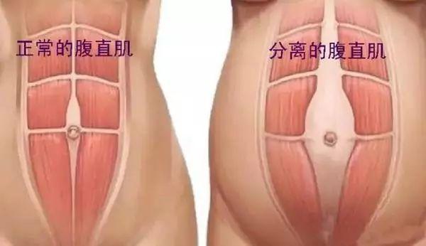 产后肚子怎么锻炼都收不回去？可能是产后腹直肌分离