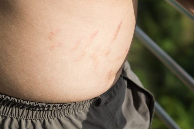 孕妈们该如何预防妊娠纹呢？