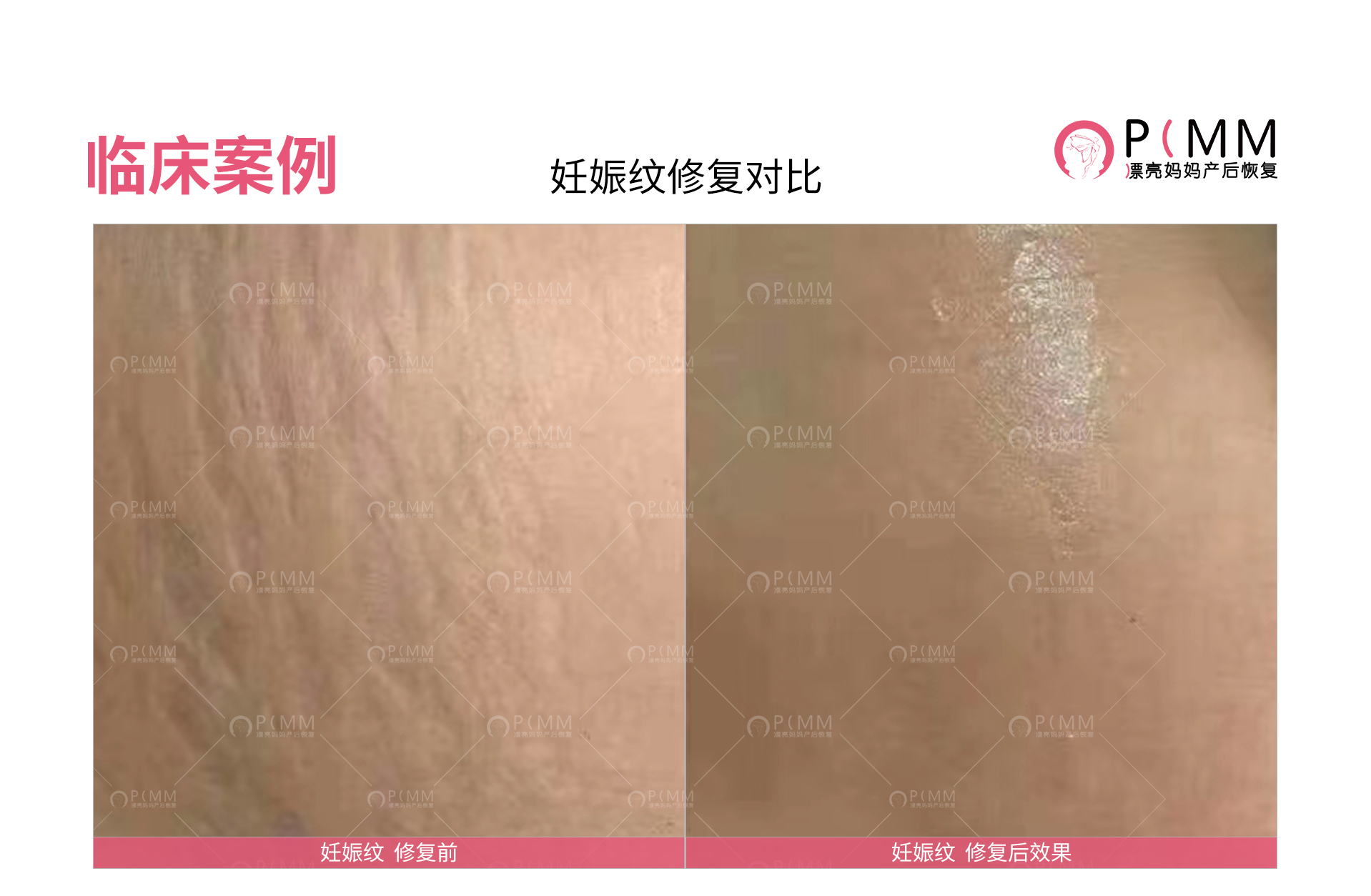 【产后恢复大课堂】如何消退产后妊娠纹？