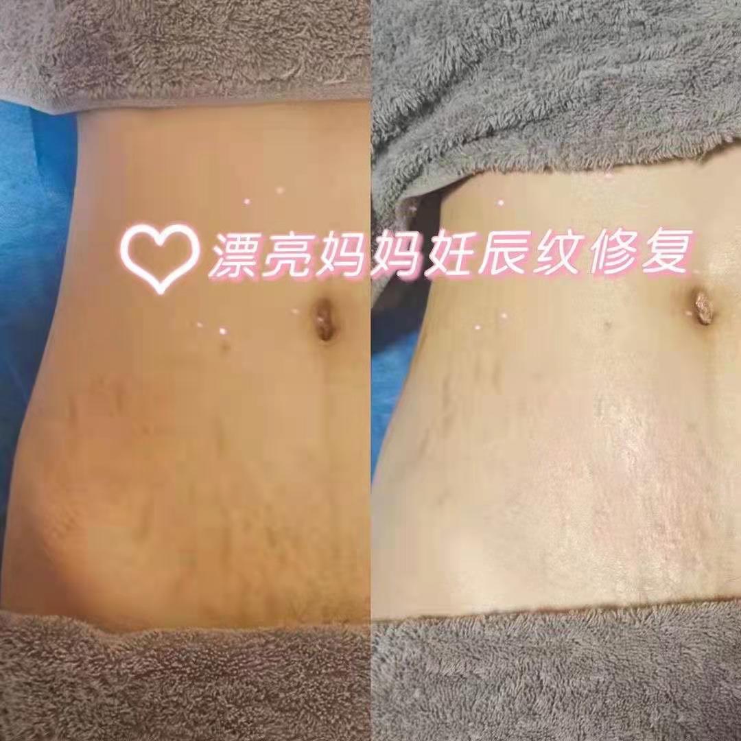 赶走妊娠纹，漂亮妈妈让你美丽如初