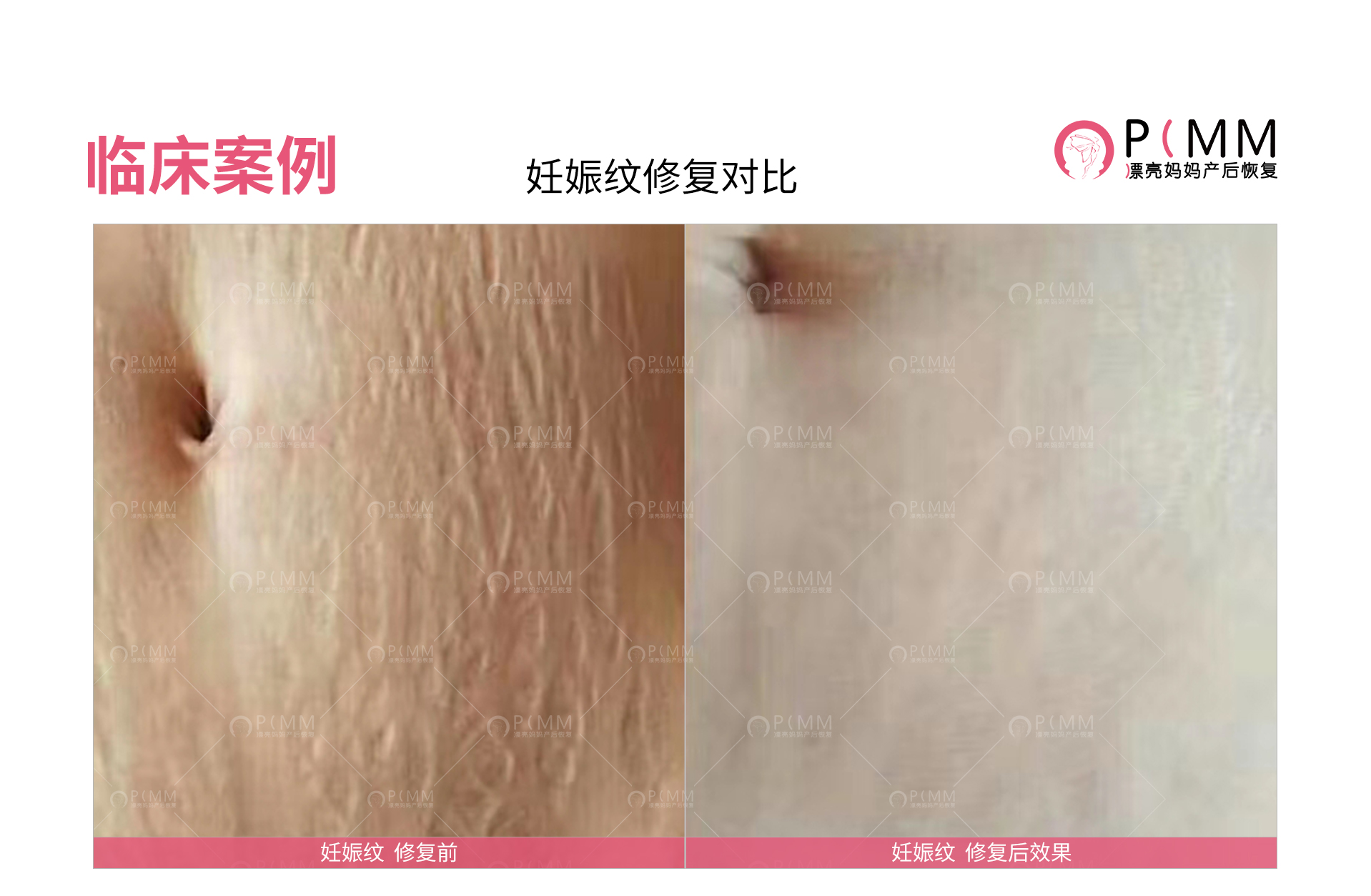 剖腹产疤痕修复