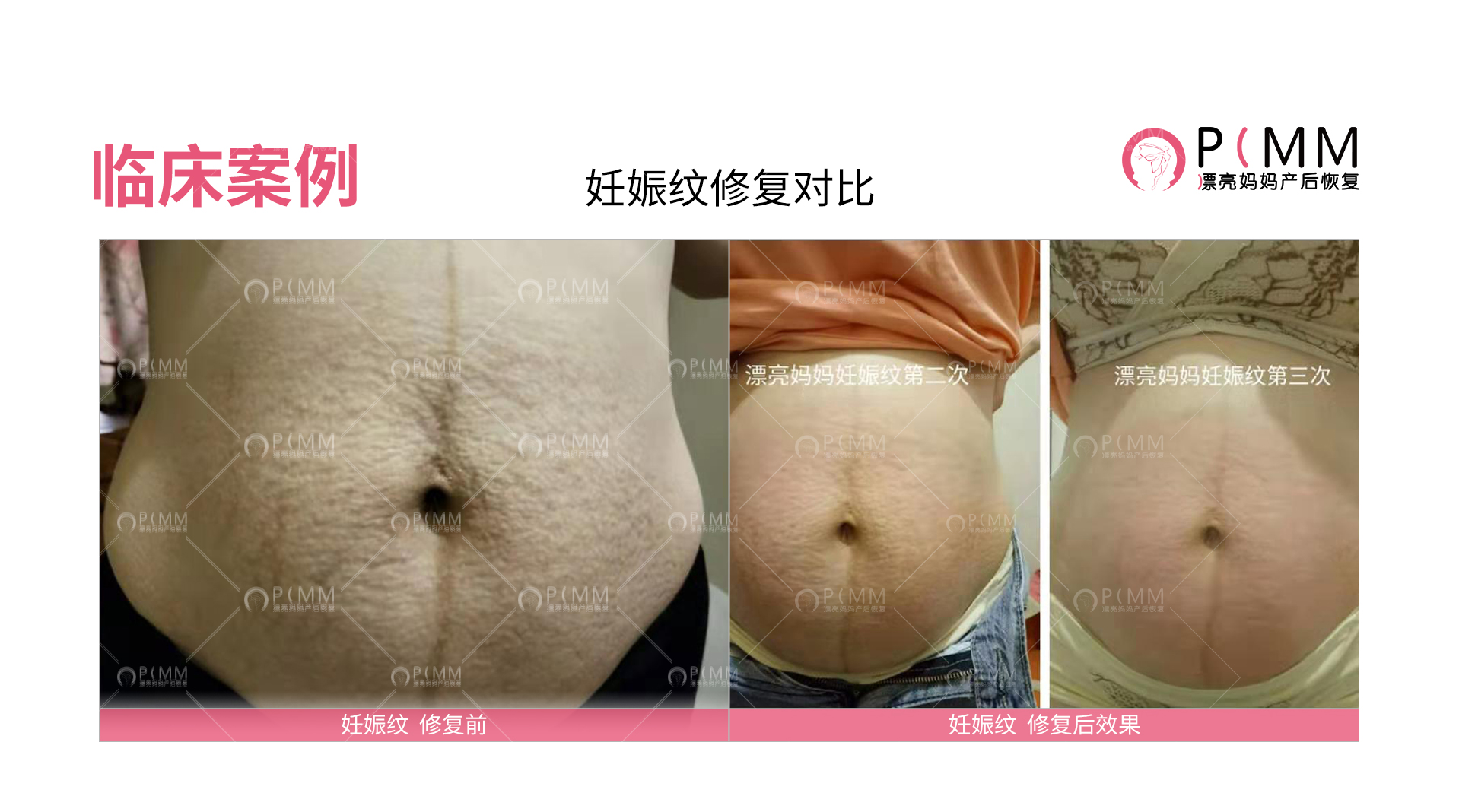 妊娠花纹会自己消掉吗?漂亮妈妈产后恢复靠谱吗?
