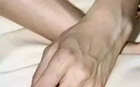 静脉曲张.jpg