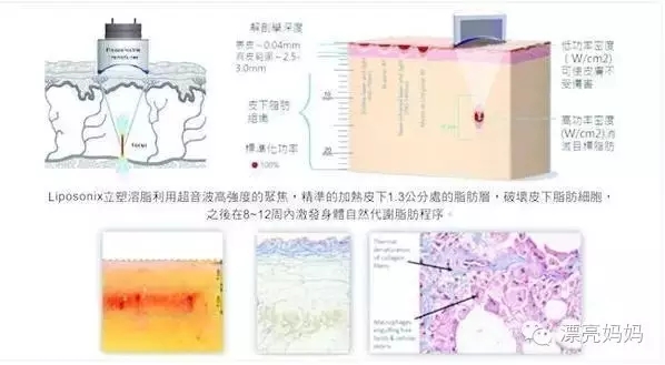 【漂亮妈妈科普篇】有一种瘦叫我是你的热立塑!